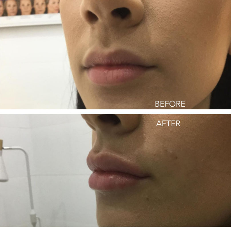 Cosmetic Injectables - Lip Filler (Before and after results)