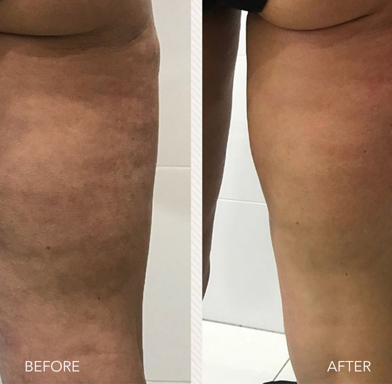 Cellulite Treatment (Before & after results)