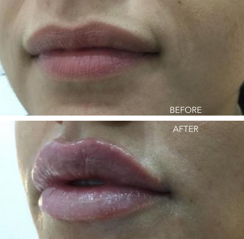 Cosmetic Injectables (Before & after)