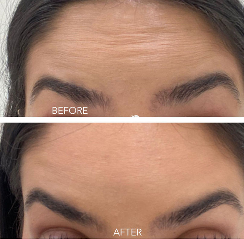 Antiwrinkle Forehead Filler (Before & After)