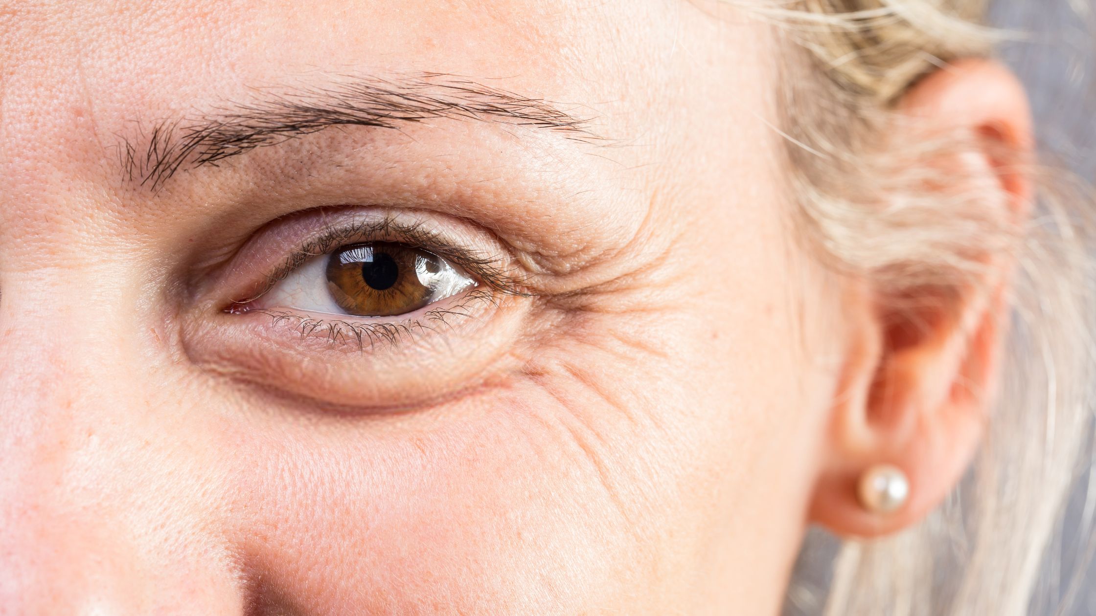 Ultimate Under Eye Wrinkle Treatment Guide